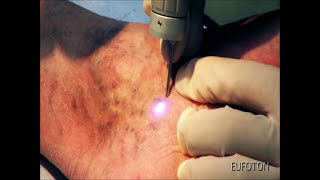 LASEmaR® 800  Transdermal Laser for Spider Veins  Laser Transdermico Teleangectasie Eufoton® [upl. by Esilec]