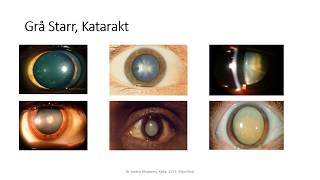 Grå starr Katarakt Cataract Operation Dr Joobin Khadamy [upl. by Stav267]