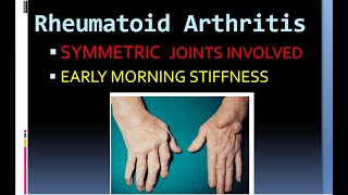 Pathology 860 Rheumatoid Arthritis Hladr4 hladr1 ankylosis pannus rheumatoid factor [upl. by Nosna]