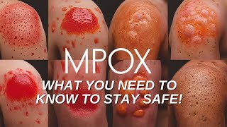 Mpox Outbreak Explained What You Need to Know to Stay Safe [upl. by Anairad45]