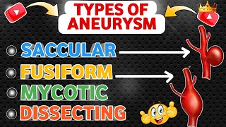 Understanding Types Of Aneurysm  Saccular  Fusiform  Mycotic  Dissecting 😍 [upl. by Koehler]