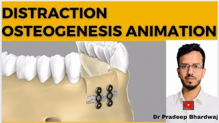 Distraction osteogenesis  animation drpradeepbhardwaj [upl. by Macilroy]