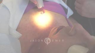 Telangiectasia Spider Angioma  VBeam Pulsed Dye Laser  Beverly Hills California [upl. by Odarnoc148]