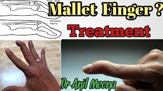 mallet finger treatment  mallet finger treatment at home  mallet finger exercises  in hindi [upl. by Ailaham]