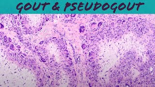 Gout amp Pseudogout calcium pyrophosphate deposition disease  chondrocalcinosis pathology USMLE [upl. by Ok439]