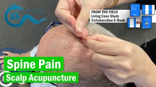 Thoracic Spine Pain treat wScalp eileenhan theacademyofacupuncture 韓玉齡 balancemethodacupuncture [upl. by Archibaldo]