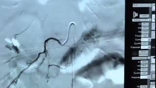 Spinal ArterAngio 033012mp4 [upl. by Esbenshade]