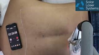 EVOLINE laser  Speed test for black hair removal Video [upl. by Halbeib]