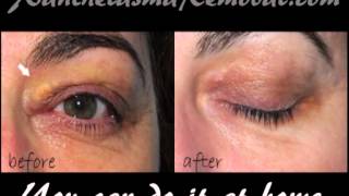 Xanthelasma removal at home [upl. by Saraiya]