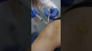 Knee Joint Aspiration and Injection with Ultrasound Guidance [upl. by Isyed]