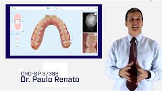 Scanner Itero Invisalign [upl. by Laurentia]