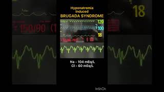 Brugada Syndrome  Hyponatremia Induced [upl. by Sparrow]