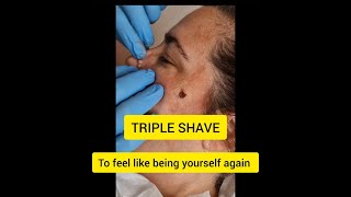 Triple Shave Excision rpmhealthclinic [upl. by Ettenot154]