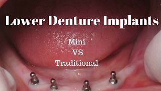 Lower Denture Implants Mini vs Traditional [upl. by Dall]