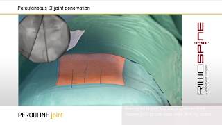 PERCULINE joint  interventional percutaneous SIjoint denervation [upl. by Schwerin]