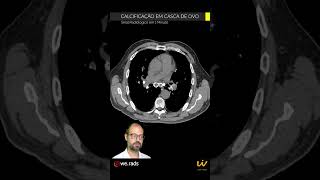 SINAL DA CALCIFICAÇÃO EM CASCA DE OVO [upl. by Attennhoj]