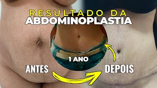 ABDOMINOPLASTIA A EVOLUÇÃO DA NOSSA PACIENTE QUE FEZ UMA ABDOMINOPLASTIA [upl. by Krm248]