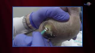 WCW Managing Diabetic Foot Ulcers  Debridement and Classifying Ulcers [upl. by Bullis]