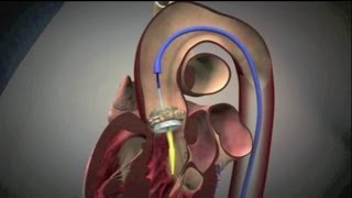 Transcatheter Aortic Valve Implantation TAVI [upl. by Afaw749]