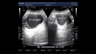 Bilateral Ovarian Cysts Two cases [upl. by Noinatrad]