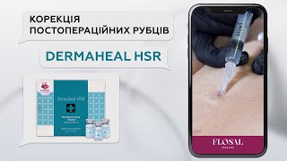 Корекція постопераційних рубців Dermaheal HSR [upl. by Aiekram]