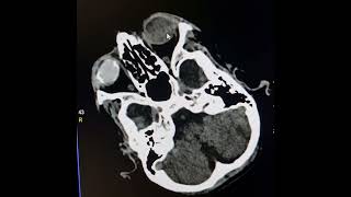 Mild cerebral atrophysilicone oil in RTeye ballLTcataract and vitreous hemorrhageArachnoid cysts [upl. by Eilrahs]