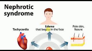 Nephrotic Syndrome  MEDICINE Lectures  NEPHROLOGY  TP 8 [upl. by Vetter]