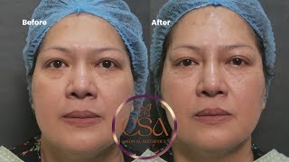 Periorbital rejuvenation undereye PDO threads foxeye nose threadlift  botox and forehead filler [upl. by Mukund687]