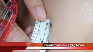 Intradermal Nevus on Cheek Removal Surgery HD 여성의 뺨에 큰 점 진피내모반 을 수술로 제거하는 방법 수원 광교 유디트성형외과 닥터랜사부 [upl. by Notlih818]