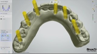 Fabrication of the BruxZir® FullArch Implant Prosthesis Vol 1 Issue 2 [upl. by Brufsky]