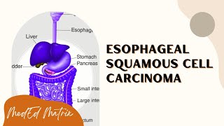 Squamous cell carcinoma of esophagus  Risk factors  Pathogenesis  Morphology  Clinical features [upl. by Enwahs]