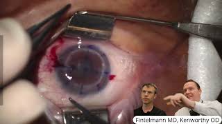 Repeat Corneal Graft to Replace Failed Graft [upl. by Assirek937]