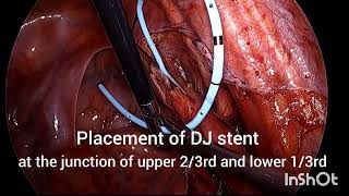 LAPAROSCOPIC URETEROLITHOTOMY FOR LOWER URETERIC STONE [upl. by Symer]