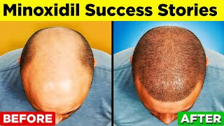 MINOXIDIL  A StepbyStep Guide to Regain Your Hair [upl. by Zachary]