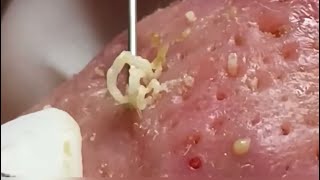 Blackheads Whiteheads Huge Pores Cystic acne Pimple popping [upl. by Avek]