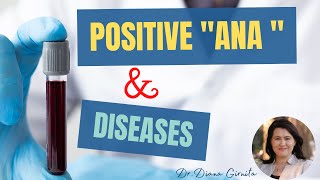 Positive ANA test antinuclear antibodies and autoimmune diseases [upl. by Yddor]