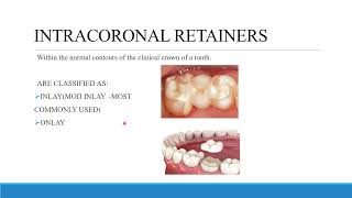 TREATMENT PLANNING FOR FIXED PROSTHODONTICS CONVENTIONAL BRIDGES AND DIAGNOSTIC WAX UP [upl. by Nylazor124]