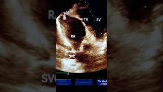 Superior vena cava subcostal view echocardiography Dr Tarvinderjit Khurana MD Patiala [upl. by Ybab]