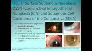 Ocular Surface Squamous Neoplasia  Presenter Carol L Karp MD [upl. by Fidelis]