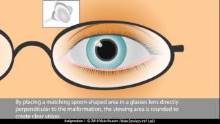 Cylinder in Prescription Glasses Astigmatism Correction [upl. by Lindahl]