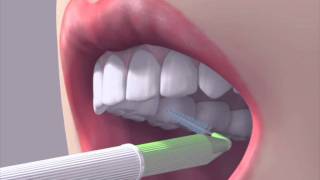 How to use an interdental brush [upl. by Killion907]