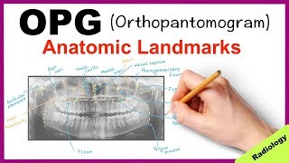 Orthopantomogram OPG Anatomical Landmarks  Radiology [upl. by Matejka480]