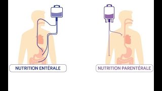 Diet à lhôpital S1 E3 quotCNO Nutrition entérale Nutrition parentéralequot [upl. by Couture]