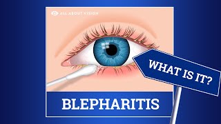 Blepharitis red swollen eyelids Causes Symptoms Treatments [upl. by Yeloc]