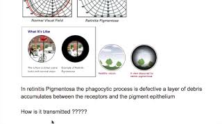 Retinitis Pigmentosa [upl. by Ahon495]