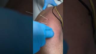 Dryneedling therapy for neck pain payal dryneedling ytshorts doctor physicaltherapy [upl. by Leksehc]