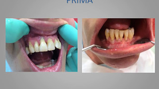 Impianti dentali prima e dopo Impianti dentali Chirurgia implantare [upl. by Enelehs]