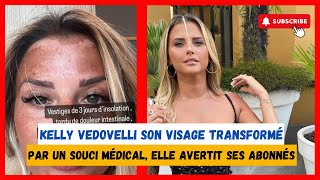 Kelly Vedovelli  visage changé par un souci de santé son avertissement [upl. by Ethelred]