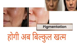 अब झाइयों का होगा सफाया maxener wellness Advance chlorophyll review pigmentation face darkspot [upl. by Znarf62]