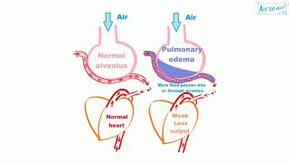 pulmonary edema [upl. by Akemor]